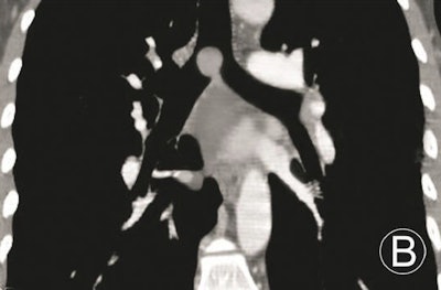 Adenoma in trachea