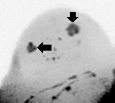 Images are of a 51-year-old woman. DWIBS MIP (above), displayed with black-white inversion, shows one lesion seen at screening (horizontal arrow) and a second lesion seen with the DWIBS protocol (vertical arrow). Transverse T2-weighted turbo spin-echo MR image (below) allows clarification of the second lesion as a simple cyst. Histopathologic examination revealed an invasive ductal carcinoma in the solid lesion, while the water-intense second lesion was an uncomplicated cyst. Images courtesy of Radiology.