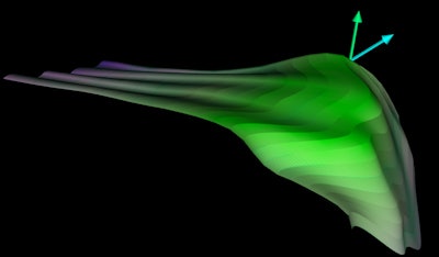 Acetabular model generated from 3D ultrasound. Image courtesy of Abhilash Hareendranathan.
