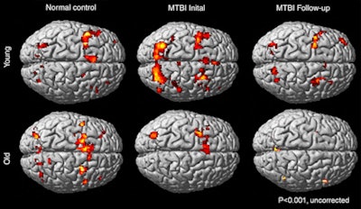 Images show different working memory activation patterns in healthy control subjects and young and old patients with mild TBI. Young control subjects (top left) had increased activation in the frontal and parietal regions, predominantly at the left hemisphere. In the initial exam, young patients with TBI (top middle) had bilateral hyperactivation in the frontal and parietal regions, compared with young control subjects. Partial recovery of the activation pattern (top right) is seen at follow-up imaging. Older control subjects (bottom left) had increased cerebral activation in bilateral frontal and parietal regions. In the initial exam, older TBI patients (bottom middle) showed hypoactivation, compared with the older control subjects. The older TBI patients had even less activation at follow-up (bottom right). Image courtesy of RSNA.