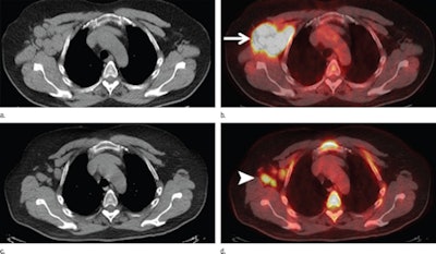 A 54-year-old man with follicular lymphoma was classified as having PET-positive results before undergoing an autologous stem cell transplant. Axial CT (a) and FDG-PET/CT (b) images before chemotherapy show lymphomatous right axillary lymph nodes (SUVmax, 15) (arrow in b). Axial CT (c) and FDG-PET/CT (d) images after chemotherapy and before stem cell transplantation show that lymph nodes (arrowhead in d) decreased in size and are FDG-avid (SUVmax, 7). Images courtesy of Radiology.