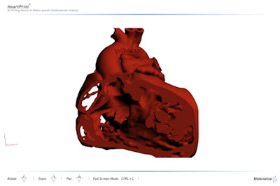 3D PDF communication tool exported from Mimics Innovation Suite.