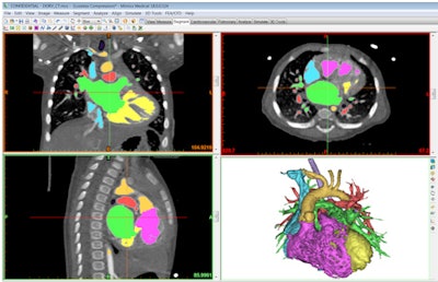 Congenital heart anatomy segmented with Mimics Innovation Suite software.