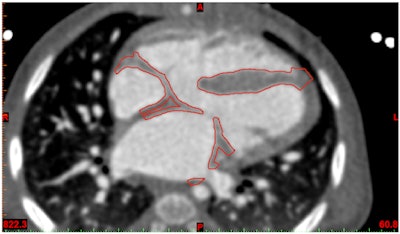 Contour verification of prepared heart model demonstrated in Mimics Innovation Suite software.