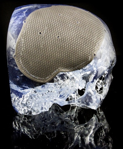 3D-printed skull defect and custom cranioplate. All images courtesy of Materialise.
