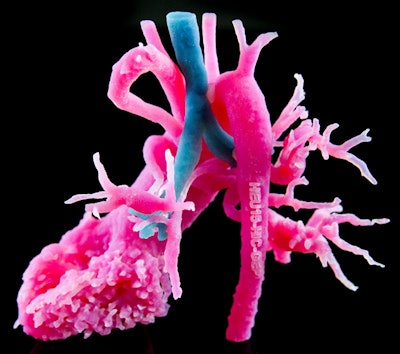 Example of a multimaterial 3D-printed model of a heart and airway anomaly.