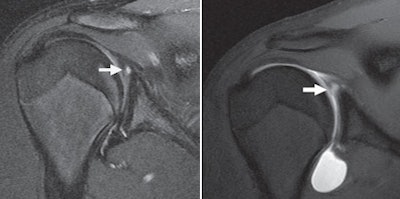 A 31-year-old man presented with shoulder pain. T2-weighted coronal MR (left) shows SLAP tear (arrow), with a T1-weighted fat-saturated coronal MR arthrogram (right) also showing a SLAP tear (arrow). There is motion of the SLAP tear by more than 4 mm, compared with unenhanced MR. Because it was ruled unstable, the tear was surgically tacked. Images courtesy of AJR.