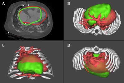 Pretransplant image of patient C (top left) and 3D virtual reconstructions (top right, bottom right, and bottom left) of the patient's anatomy (red) and virtual donor implanted (green). The technique could potentially enable 'virtual transplantations,' allowing clinicians to model a particular donor (green) into a patient-specific recipient (red) and assess fit, along with the potential for mismatch-related morbidity. Image copyright: Cardiac 3D Print Lab, Phoenix Children's Hospital Heart Center.
