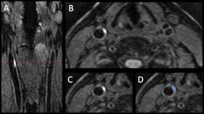 The 3D MRI intraplaque hemorrhage sequence (A) is acquired in the coronal plane. The red dotted line indicates the level at which the reformatted axial plane (B) was obtained. The section of the right carotid artery (C) with a region of high signal is consistent with hemorrhage. Contours are drawn (D) for the outer wall (green) and lumen (red) with the area of hemorrhage (blue). Images courtesy of Dr. Tishan Maraj and RSNA.