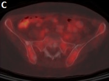 Fused FDG-PET/CT