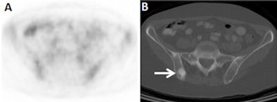 A 56-year-old woman with initial stage III invasive lobular cancer is upstaged to stage IV based on the CT component of FDG-PET/CT. The axial FDG-PET image (A) does not demonstrate suspicious foci, but the axial CT component (B) shows multiple osseous sclerotic lesions, suspicious for metastases (solid arrow). Axial fused FDG-PET/CT (C) confirms that the osseous sclerotic lesions demonstrate background FDG-avidity. Biopsy confirmed an osseous metastasis. Images courtesy of Dr. Gary Ulaner and Dr. Molly Hogan.
