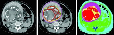The CTDIvol-to-SSDE dose conversion technique used voxelized models created from patient images, based on Hounsfield Unit-to-density lookup tables, with the fetus modeled as water, soft tissue, or bone depending on attenuation. Images courtesy of Kyle McMillan.