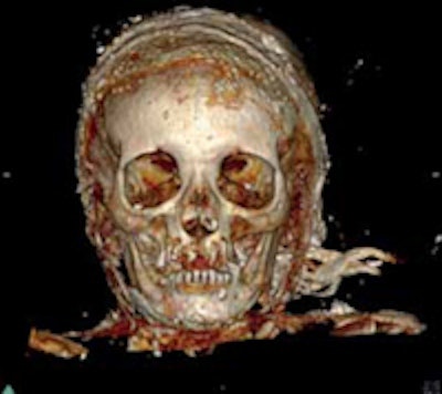 A 3D reconstruction with volume rendering of the head, frontal view. All images courtesy of Journées Françaises de Radiologie (JFR).