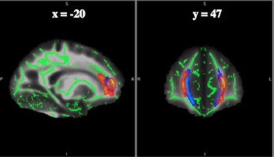 The statistical heat map for the concussion-position interaction is shown in red-orange. The major clusters were within the frontal white matter, specifically within the forceps minor (blue). This result suggests there may be a modifying effect of subconcussive impact exposure on damage to white-matter structures caused by recurrent concussions. This modifying effect appears most prominently in the frontal white-matter structures. The implications of such white-matter structural changes on late-life cognitive function are unknown. Images courtesy of Allen Champagne and Michael Clark.