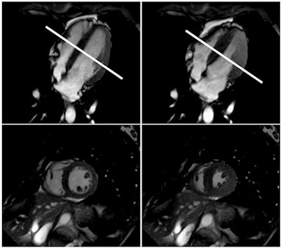 Cardiac MRI shows normal left-ventricular function in the standard horizontal long axis (upper two images) and corresponding short axis (lower two images) in diastole (left) and systole (right) at the midventricular section of the heart (white line). Images courtesy of RSNA and Dr. Jonas Dörner.