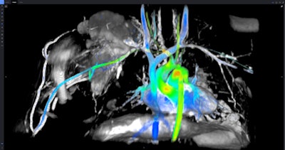ViosWorks combines 3D cardiac anatomy, function, and flow in a single free-breathing scan.