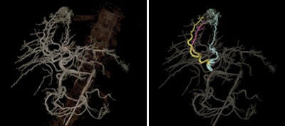 Interventional images demonstrate before (left) and after (right) the use of FlightPlan for Liver.