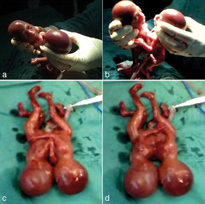 Figure 4: Photographic images (a-d) show the thoraco-omphalopagus conjoined twins immediately after delivery.