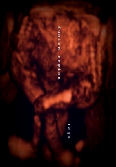 Figure 2: Three-dimensional ultrasound image shows two fused fetuses with free lower limbs.