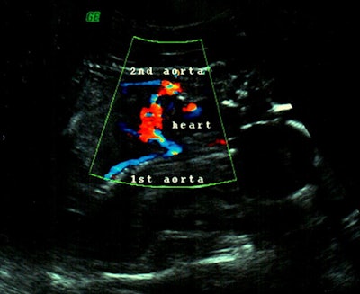 Figure 3: Transabdominal color Doppler ultrasound shows single central heart with two aortic arches and two descending aortas.