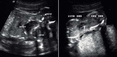 Figure 1: Grayscale transabdominal ultrasound. Longitudinal (left) and transverse (right) views show the fusion site with single central heart.