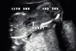 2015 12 09 18 15 29 266 Conjoined Twins Us1 20151210013844