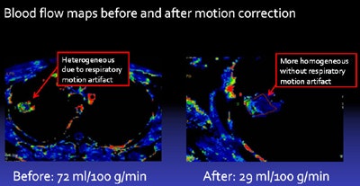 Blood-flow maps before and after motion correction show that the image of the tumor after motion correction has much greater homogeneity, resulting in reduced variability in tumor blood-flow measurement. Image courtesy of Dr. Lisa Chu.