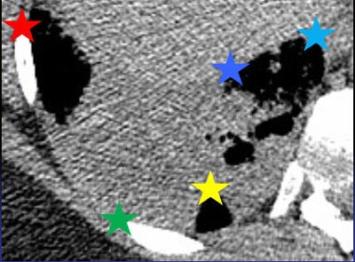 The MedInria rigid motion correction algorithm places anatomic landmarks (stars) on all images, which are then registered using nonrigid motion correction. Image courtesy of Dr. Lisa Chu.