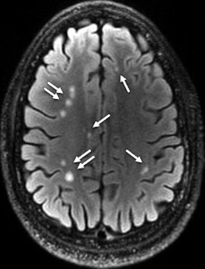A 28-year-old man with blast-related TBI had multiple white-matter T2-weighted hyperintensities (arrows). Axial T2 FLAIR MRI discovered a total of 76 lesions on all sections. Image courtesy of Radiology.