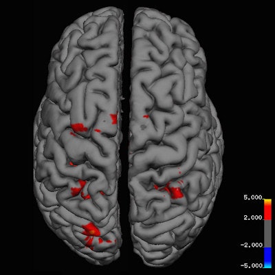 Danish researchers identified areas of heightened brain activity in people who celebrate Christmas, compared with those who have neutral feelings. All images courtesy of BMJ.