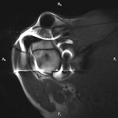 By comparison, the MR arthrogram offers virtually no details of the loose screw or rotator cuff tear.