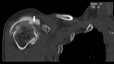 CT of second tear and screw