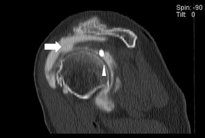 The CT image above shows a loose metallic screw (bottom arrow) and a rotator cuff tear (left arrow). The same CT below shows a second tear and loose screw (arrow). All images courtesy of Dr. Thomas Magee.