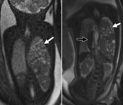 MR images show two 31-week-old fetuses with left congenital diaphragmatic hernias. Coronal SSFP MR images were obtained at 1.5 tesla (left) and 3 tesla (right). The bowels (white arrows) were herniated in both fetuses, but the bowel wall was better visualized at 3 tesla (right) than at 1.5 tesla (left). A herniated spleen (black arrow, right) was also seen in the 3-tesla image in one fetus. Images courtesy of AJR.