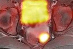 2016 01 12 17 14 25 164 Gado Fdg Pet Mri 01 Bottom 430 20160113002048