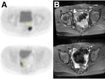 Agreement is achieved with FDG-PET avidity and gadolinium contrast enhancement in a 10-year-old girl after resection of immature teratoma. FDG-PET (A) demonstrates two foci of marked glucose hypermetabolism in left and right lower pelvis (arrows). The T2-weighted MRI (B) shows the foci correspond to small soft-tissue nodules outlined by pelvic fluid, while the T1-weighted MRI (C) after contrast administration shows enhancement of these nodules (arrows) and T2-weighted PET/MRI (D) details the nodules amid pelvic fluid. Images courtesy of JNM.