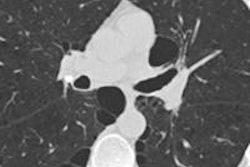 2016 01 13 12 12 23 219 2016 01 Paraseptal Emphysema Chiles Bottom 20160113191649