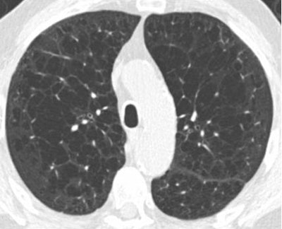 Above, patient with centrilobular emphysema; below, patient with paraseptal emphysema. Both COPD phenotypes were associated with malignancy in nodules 6 mm to 19 mm in diameter at CT lung cancer screening. Images courtesy of Dr. David Gierada and Dr. Caroline Chiles.