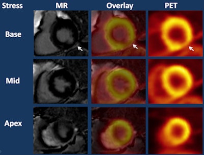 Late gadolinium enhancement images (left column) show infarction in the inferolateral wall (arrow) and PET stress perfusion images (right column) show hypoperfusion in the same region (arrow) that was slightly larger than the infarct. PET/MRI (middle column) indicates mixed infarct/ischemia. Image courtesy of Dr. Amir Durrani.