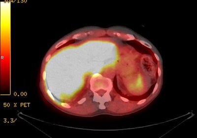 Liver Activity