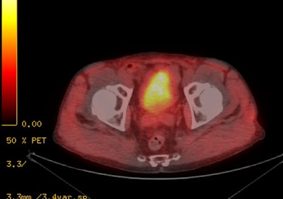 Urinar Bladder