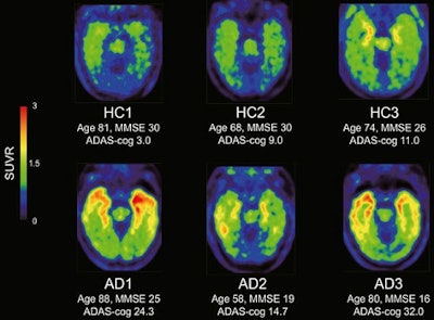 THK5351-PET scans 40 to 60 minutes after injection show retention in the temporal lobe, which distinguishes Alzheimer's disease (AD) patients from healthy elderly participants (HC). Image courtesy of JNM.