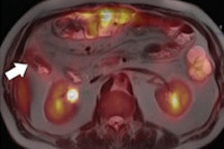2016 02 18 16 53 40 485 2016 02 19 Pet Mri Crohns Thumb
