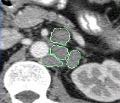 An image transformation scheme was designed to produce enhanced input for low-level HOG features to make them 'deeper.' The scheme would learn lymph-node-selective visual responses from manual radiologist annotations. All images courtesy of Dr. Ronald Summers, PhD.