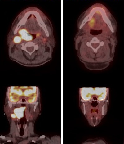 PET/CT images illustrate a patient's initial staging and treatment planning (left column) and the response to three months of radiation therapy (right column). Image courtesy of Dr. Jessica Frakes.