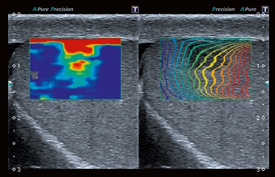 Leydig cell in the testis is shown using sheer-wave elastography. Image courtesy of Toshiba.