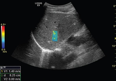 Fibrosis staging with 2D shear-wave elastography performed on the Logiq XDclear unit. Image courtesy of GE Healthcare.