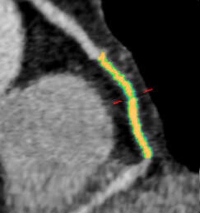 Woman age 61 years with a history of arterial hypertension, hyperlipidemia, and an abnormal stress test. Initially, CT angiography revealed patent coronary arteries and no significant stenosis, but after the patient had a myocardial infarction, a retrospective plaque analysis showed a 75% reduction in lumen volume in the mid right coronary artery; the culprit plaque had a lipid component of approximately 60% and a fibrotic component of about 40%. The mid right coronary artery was the most common location for culprit plaques in the patient cohort. Image courtesy of Dr. Stefanie Mangold and Stephen Fuller.