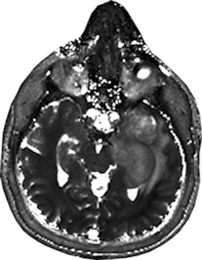 MR fingerprinting T2 map