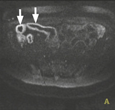 Axial b800 DWI though the ileum, pretreatment in a 22-year-old patient with active Crohn